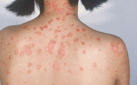 银屑病患者饮食禁忌