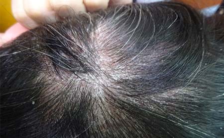头部银屑病症状,轻度头部银屑病症状
